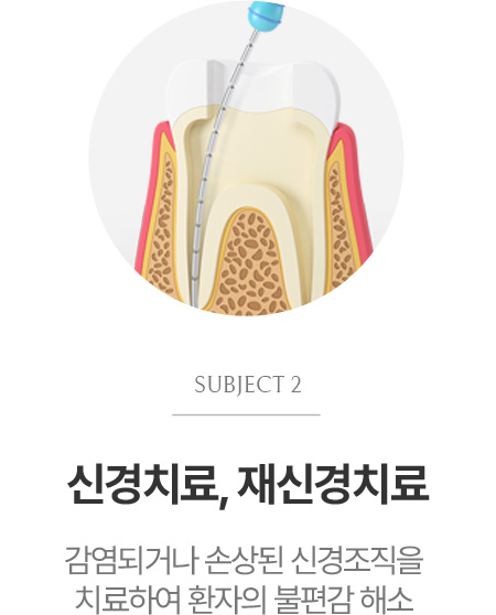 신경치료, 재신경치료